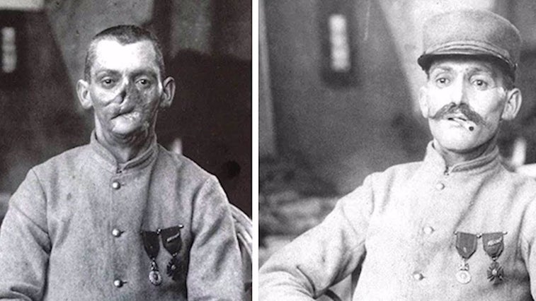 Why disfigured World War I veterans had their own park benches