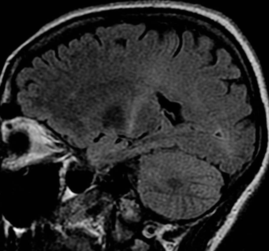 MRI of a brain potentially at risk for ALS (<a href="https://commons.wikimedia.org/wiki/File:ALS_Coronal.jpg" target="_blank" rel="noreferrer noopener">Wikimedia Commons</a>)