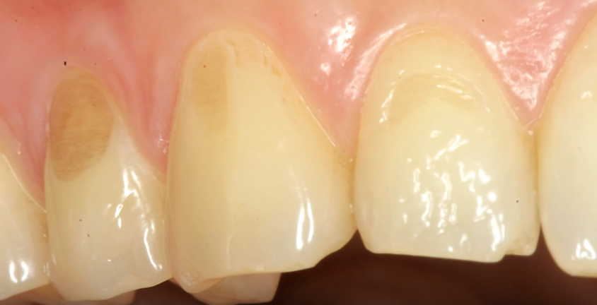 Tooth damage caused by drinking vinegar.