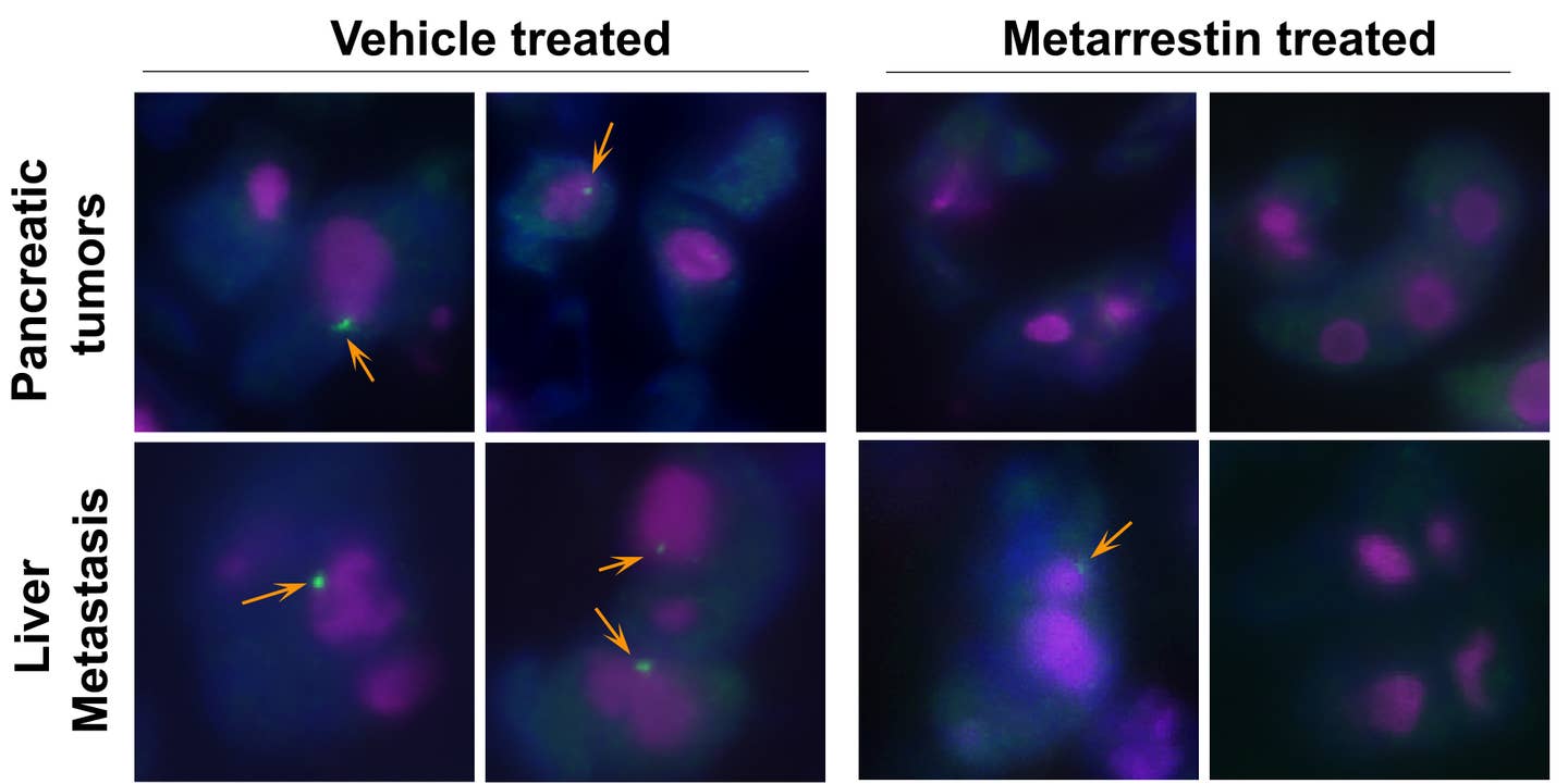 In the four panels on the left, the green dots indicate the presence of PNCs in untreated pancreatic and metastatic liver tumors. On the right, treatment with metarrestin reduced the prevalence of PNCs.