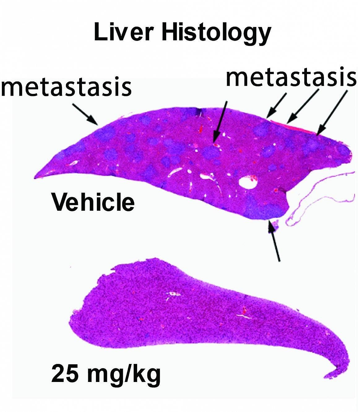 In this image, the liver of an untreated mouse (top) shows metastatic tumors (arrows). After treatment with metarrestin, the tumors are greatly reduced (bottom)