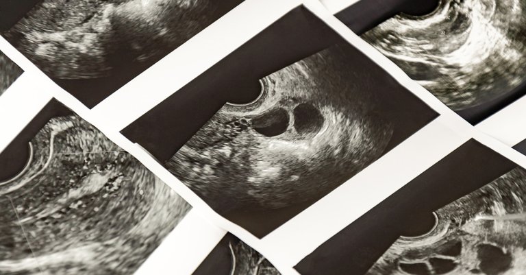 Medical ultrasound, diagnostic sonography or ultrasonography of foliculometry in the protocol of the ivf program in the process of hormonal stimulation